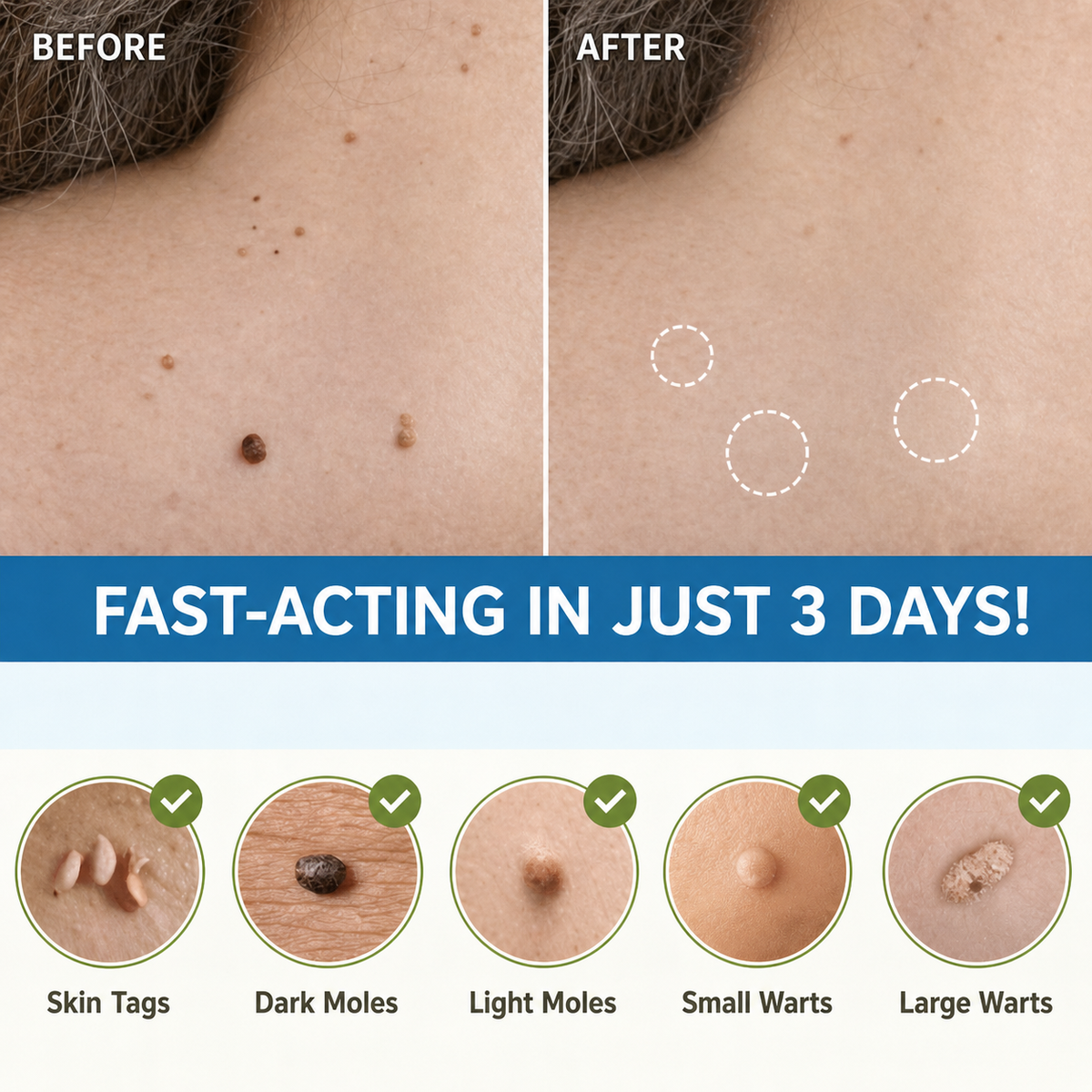 Skin Tag Remover Patches | Painless Gentle Skin Tag Removal Patch 4