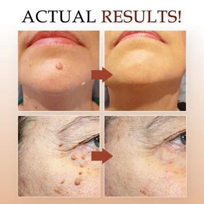 Effective Skin Tag & Mole Remover for Clear Skin 4